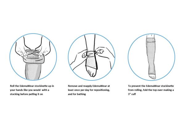 EdemaWear Open-Toe Stockinet